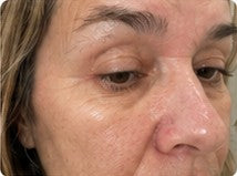 Close-up customer result showing natural skin texture