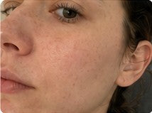 Close-up customer result showing ordinary skin texture