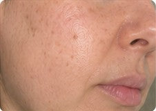 Close-up customer result showing pores and natural texture