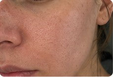 Close-up customer result showing natural pores